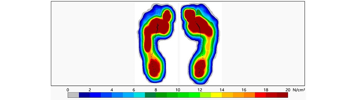 Spiraldynamik® - Evidenz-Update bei Knicksenkfuss