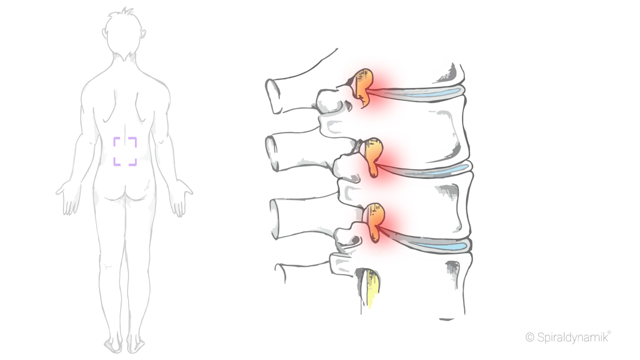 Therapie Spinalkanalstenose