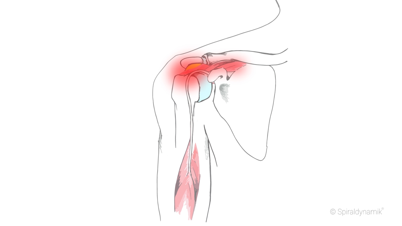 Therapie Schulter Impingement